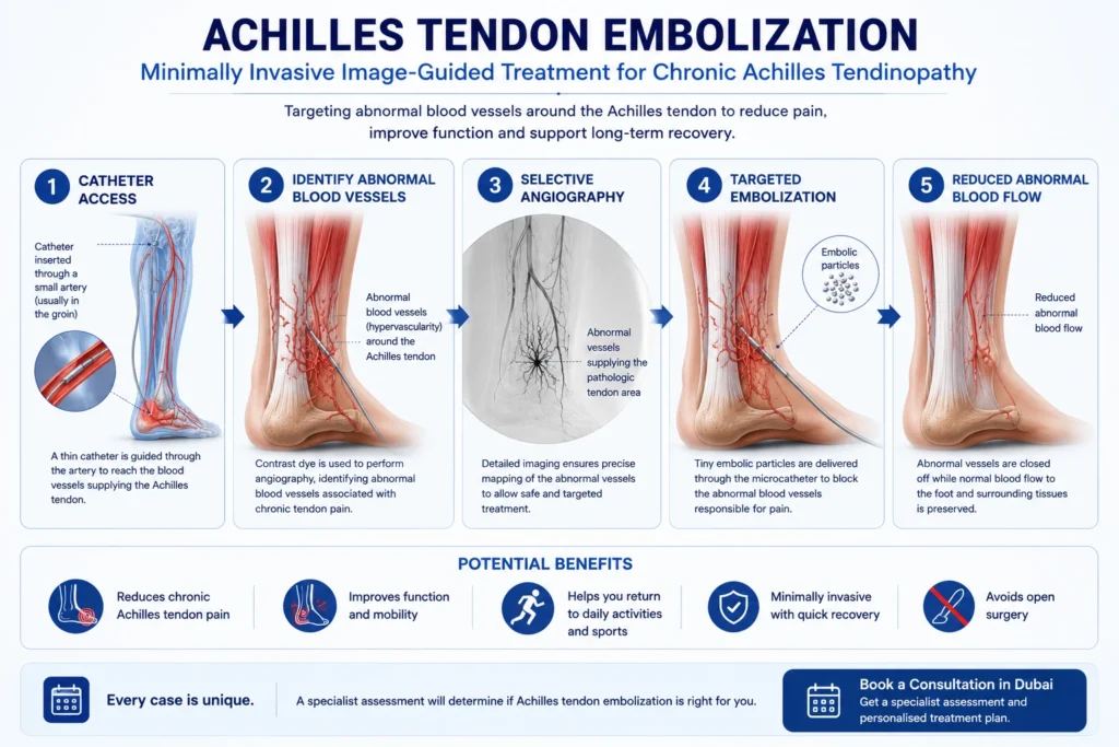 Achilles tendon embolization procedure for chronic Achilles tendinopathy in Dubai