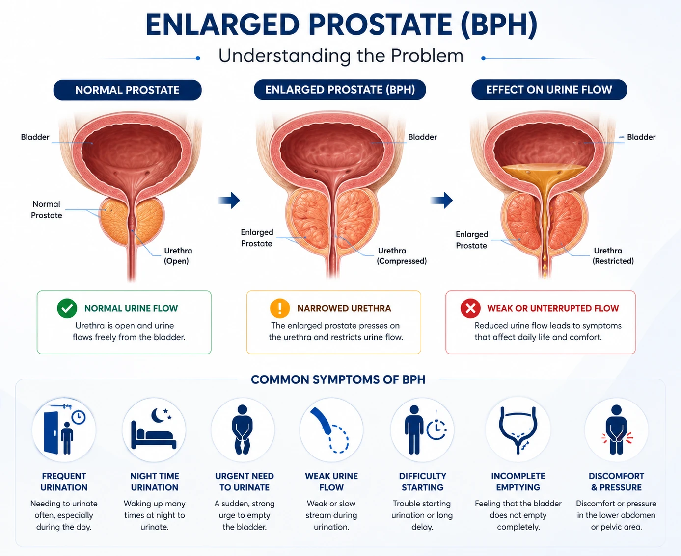 Enlarged Prostate (BPH) Symptoms & Anatomy