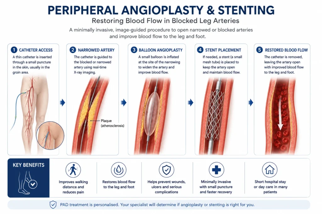 Peripheral angioplasty and stent procedure restoring blood flow in a blocked leg artery